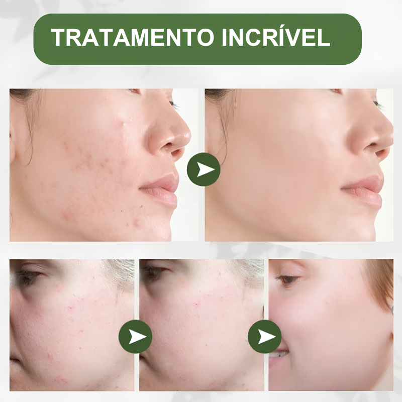 Removedor Facil Aviz - Anti-Acnes e Rejuvenecedor