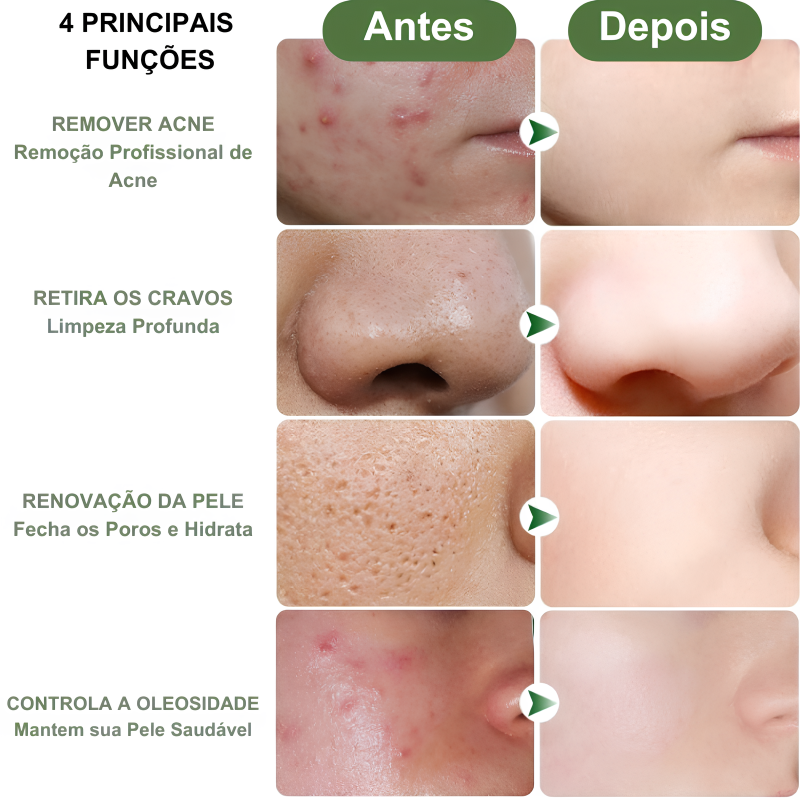 Removedor Facil Aviz - Anti-Acnes e Rejuvenecedor